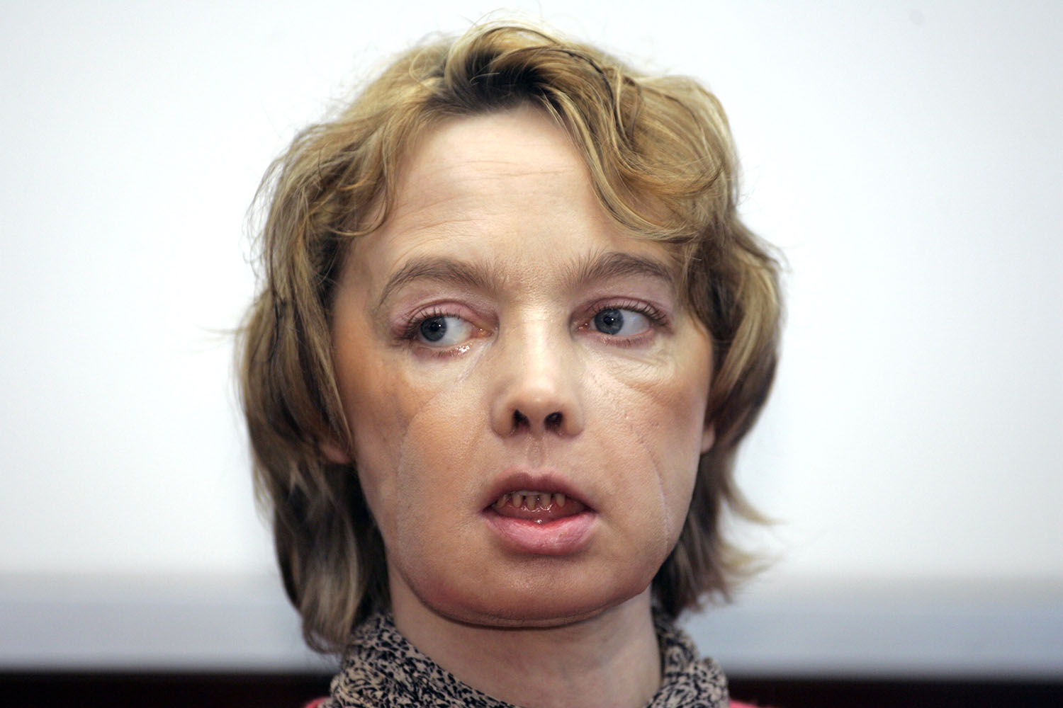 Frenchwoman who got world's 1st face transplant dies at 49